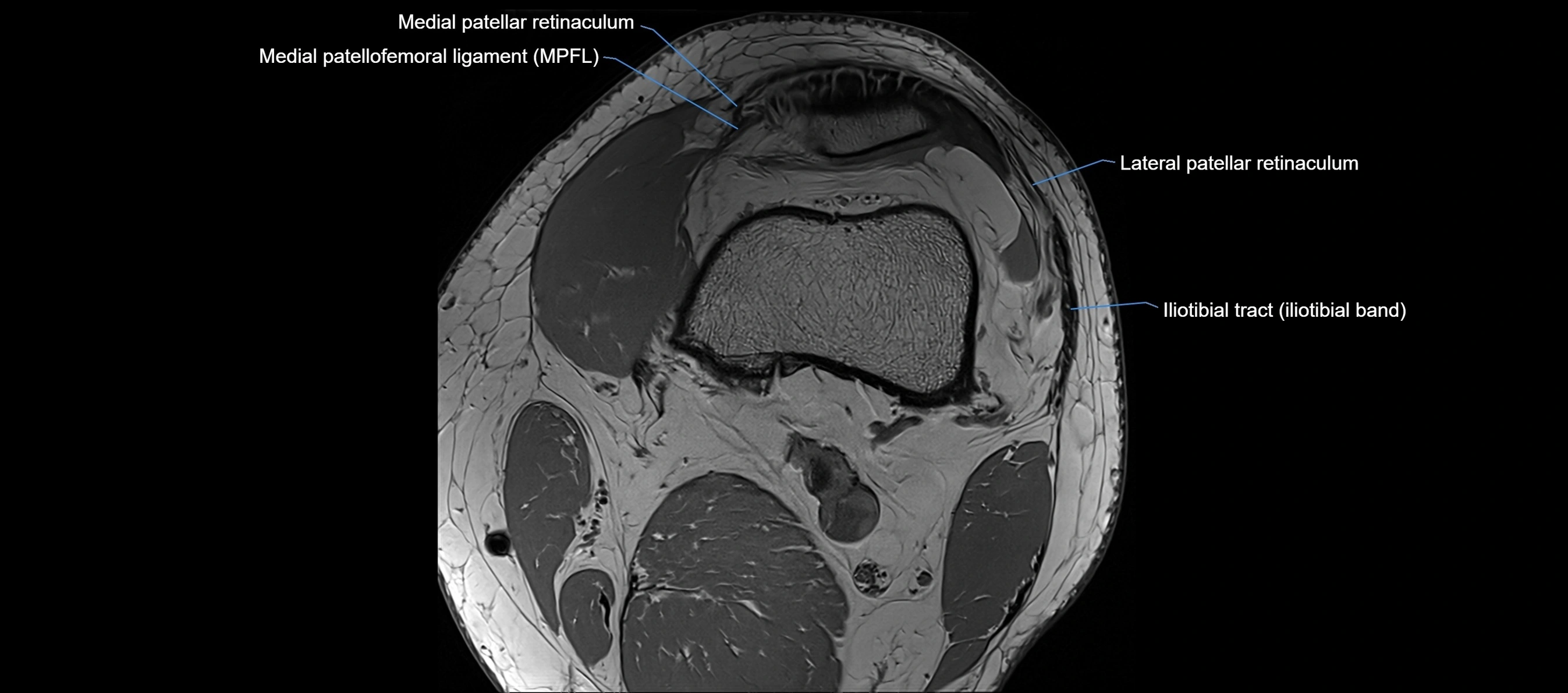 MRI Knee axial  ligaments cross sectional anatomy 3T  radiology  image-img-03001-00008.webp